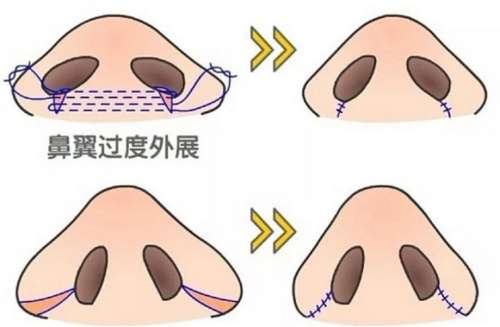 鼻翼缩小