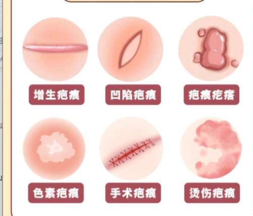 祛疤.jpg