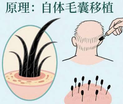 植发