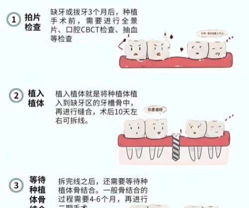 牙齿种植