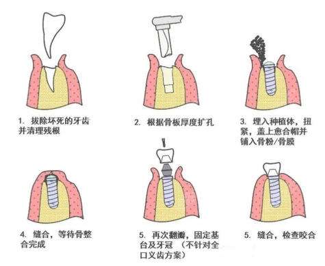 牙齿种植