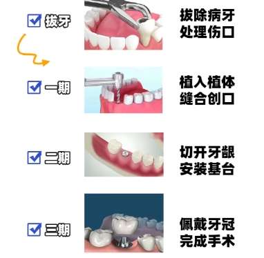 牙齿种植