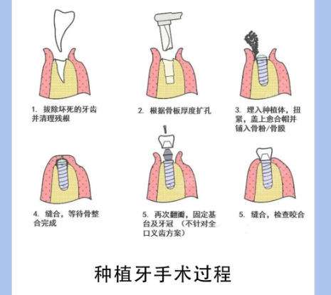 牙齿种植