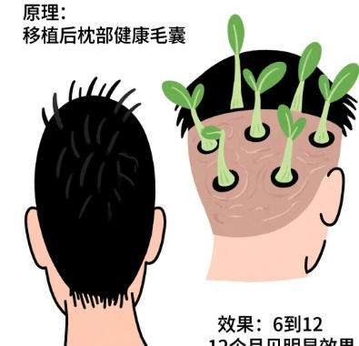 植发
