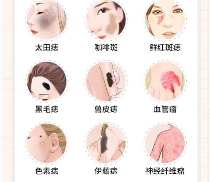 去胎记