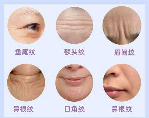 除皱