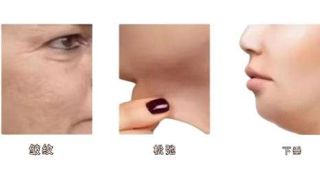 热玛吉