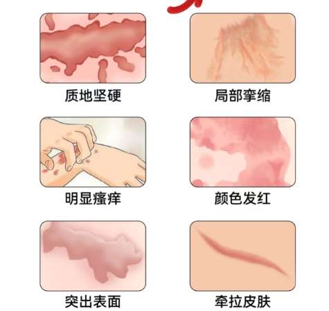祛疤