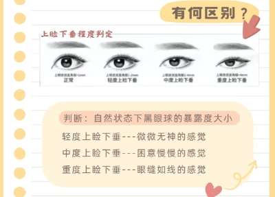 双眼皮修复