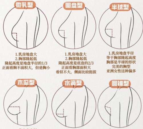 隆胸