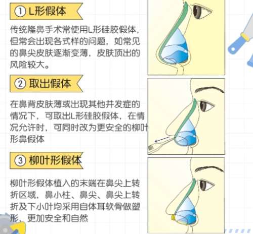 隆鼻