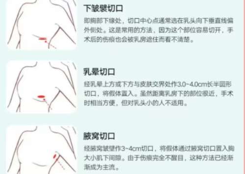 脂肪隆胸