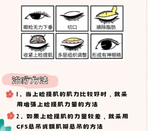 上睑下垂
