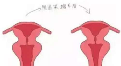 私密紧缩