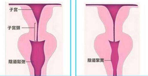 私密紧缩