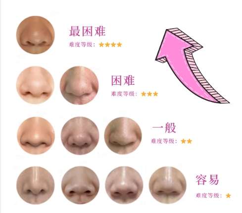隆鼻