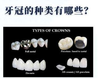 烤瓷牙