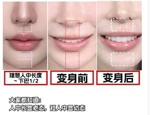 人中缩短