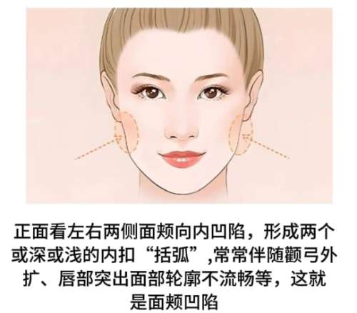脂肪填充