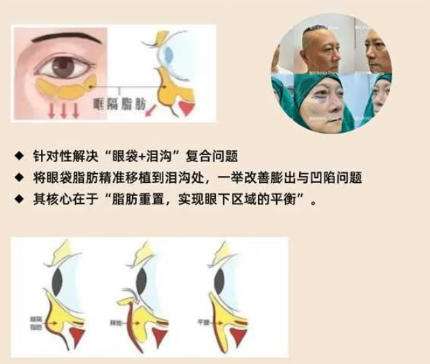 去眼袋