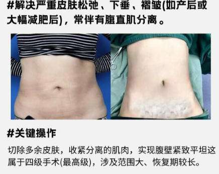 腰腹吸脂