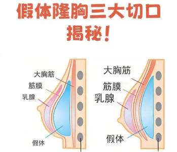 隆胸