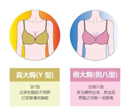 隆胸