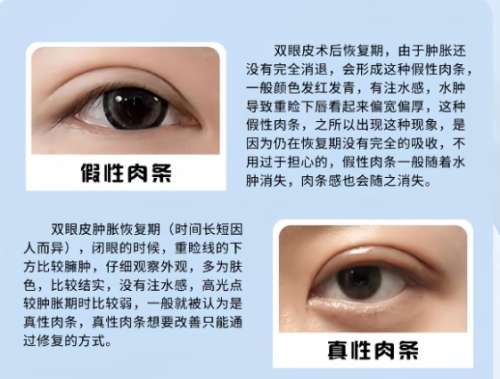 双眼皮