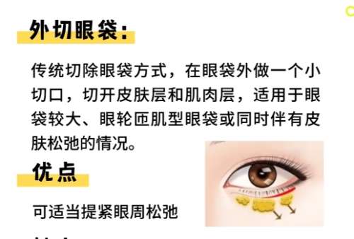 眼袋切除