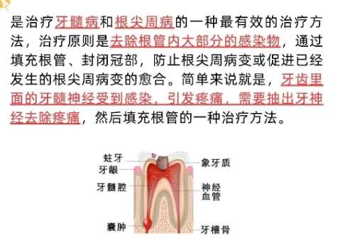 根管手术