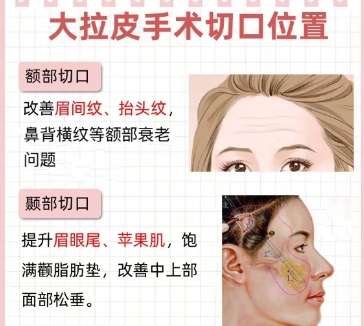 拉皮
