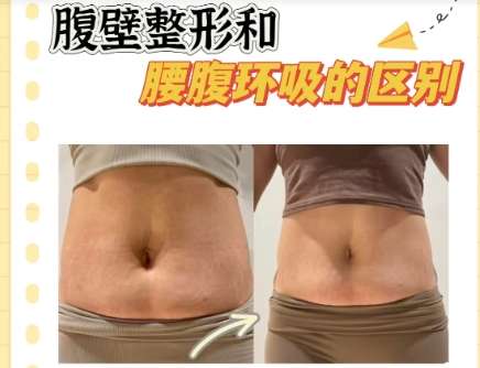 腰腹吸脂
