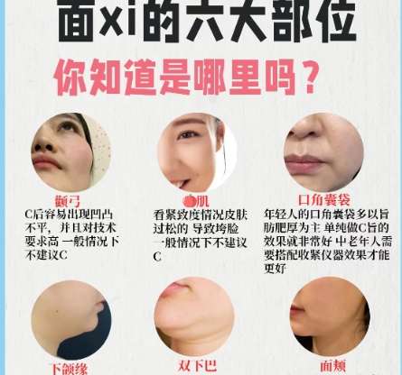 面部吸脂