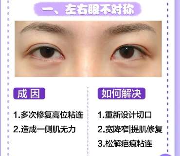 双眼皮