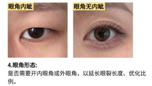 双眼皮修复