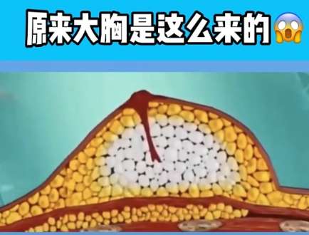 脂肪隆胸