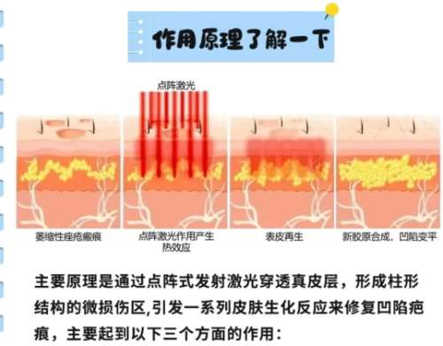 点阵激光