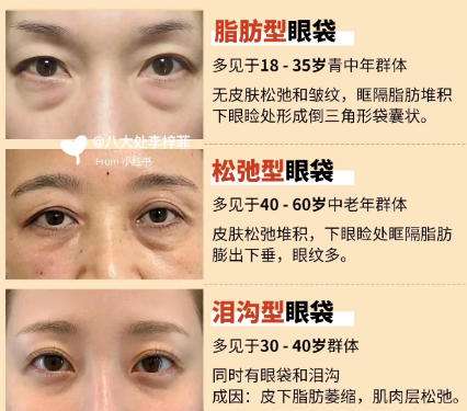 去眼袋
