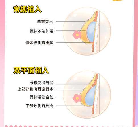 隆胸假体.jpg