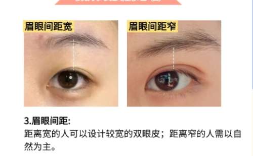 双眼皮
