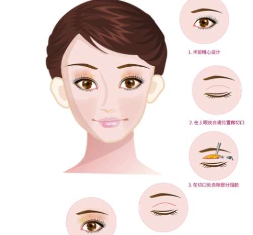 双眼皮 双眼皮