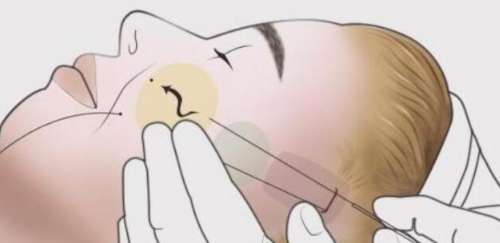 内窥镜除皱 内窥镜除皱