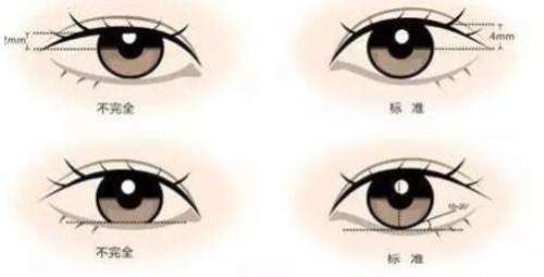 双眼皮 双眼皮