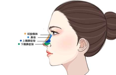 膨体隆鼻