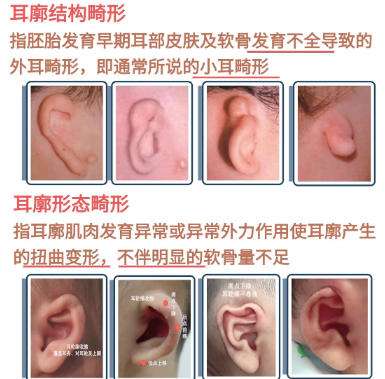小耳矫正 小耳矫正
