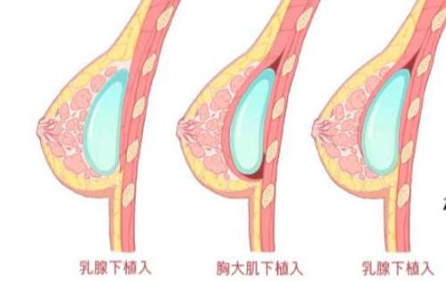 隆胸