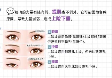 双眼皮知识科普.jpg