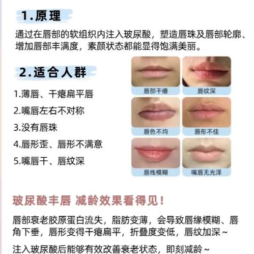玻尿酸丰唇
