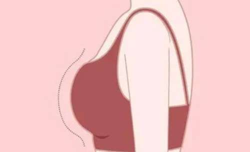 隆胸