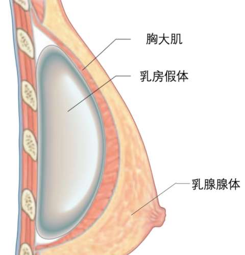 隆胸